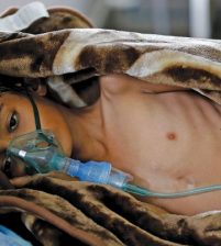200 الف حالة كوليرا في اليمن